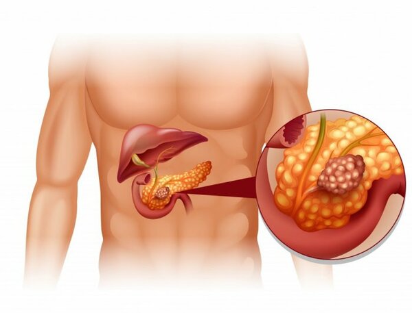 ������������� ������ �������� ����������� ��������������� ��������� (����: Diabetesnewsjournal.com)