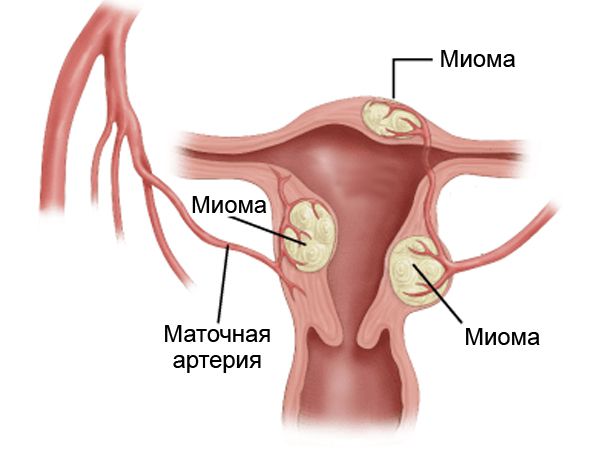 Миома матки Миома матки