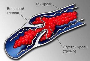 Как уменьшить вязкость крови народными средствами Как уменьшить вязкость крови народными средствами