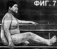 Знаки вырождения Знаки вырождения