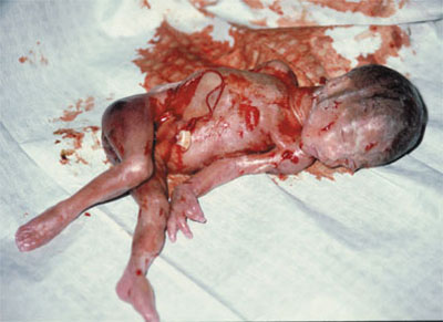 Аборт в 22 недели