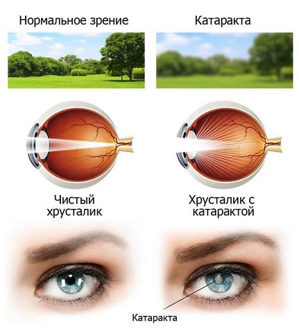 Катаракта. Она у всех впереди. Как лечить? Катаракта. Она у всех впереди. Как лечить?