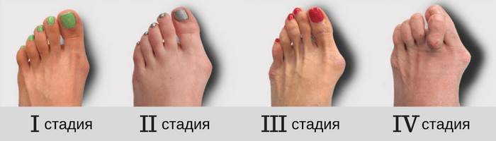 Воспалительные заболевания суставов - это заболевания лимфатической системы Воспалительные заболевания суставов - это заболевания лимфатической системы