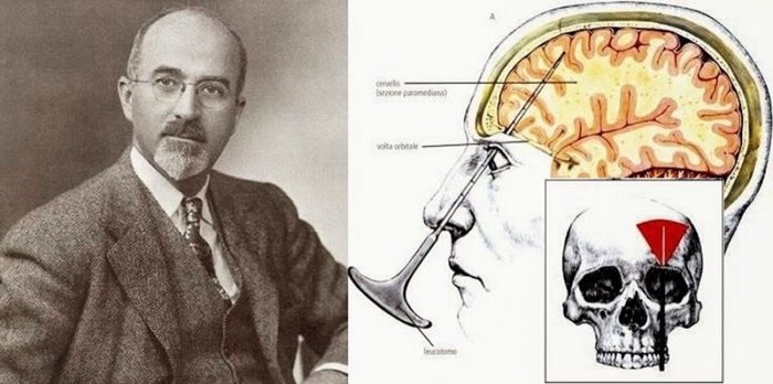 Лоботомия - истинное лицо медицины Лоботомия - истинное лицо медицины